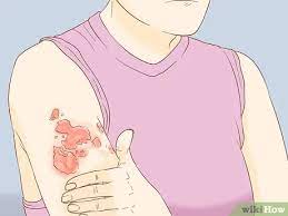 3 Ways To Treat A Skin Fungal Infection - Wikihow