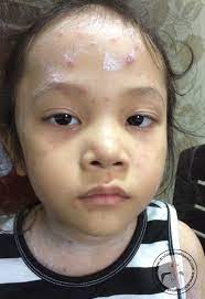 Chicken pox (or varicella) is a viral infection that causes a unique rash. 10 Perkara Kena Tahu Bila Anak Kena Chickenpox Dr Shima Mat Saad