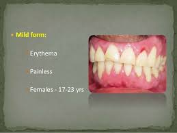 Mild Form Erythema Painless Females 17 23 Yrs Gingivitis Painless Mild