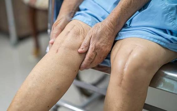 When Does Knee Replacement Become Necessary? | Spica Hospitals