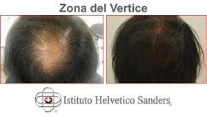 Ecco le informazioni necessarie per procedere. Pin Su Trapianto Capelli Smart Fue