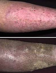 La trombosis venosa profunda y la embolia pulmonar (tvp y ep) son afecciones que no se diagnostican con frecuencia y son graves, pero se pueden prevenir. Insuficiencia Venosa Cronica Y Sindrome Posflebitico Trastornos Del Corazon Y Los Vasos Sanguineos Manual Msd Version Para Publico General