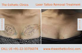 Each laser tattoo removal patient should expect unique results based on a number of independent factors tattoo removal can be more an art than an exact science, so it can be difficult to identify the exact number of treatments that will be needed to remove a tattoo completely. Tattoo Removal Mumbai Permanent Laser Tattoo Removal Treatment Cost India The Esthetic Clinics