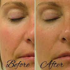 Hydrafacial Before And After Realresults Hydrafacial Facial Skincare Beauty Face Skin Spa Hydra Facial Best Skin Care Routine Essential Oil Anti Aging
