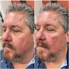 Irene Ware- Nurse Injector