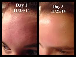 This Is My Story And It S Pretty Simple I Had Awful Bumps All Over My Forehead And Nothing Was Helping M Forehead Acne Forehead Bumps Little Bumps On Forehead