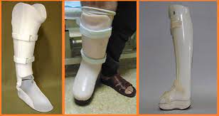 Miami tibial fracture brace permits joint mobility and early return to normal activities. My Care Prosthetics And Orthotics On Twitter Ptb Brace Tibial Fracture Brace My Care Prosthetics Orthotics Near Fever Hospital Ptbbrace Tibialbrace Fracturebrace Patellafracturebrace Tibialfracture Brace Ptbfracturebrace Postoperativebrace