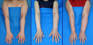 lenfodem tani ve tedavi rehberi prof dr mustafa sehsuvar gokgoz