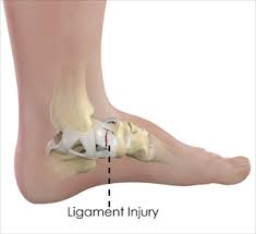 Ankle Ligament Injury El Paso | Ankle Ligament Tear El Paso