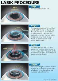 See full list on mayoclinic.org Eye Surgery Houston Lasik Experience Of Houston Eye Surgery