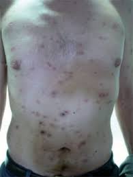 Beide erkrankungen können sich gegenseitig im verlauf ungünstig beeinflussen. Syphilis Lues