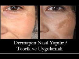 Dermapen Uygulamasi Nasil Yapilir Nedir Oncesi Sonrasi Makyaj Nasa Videolar