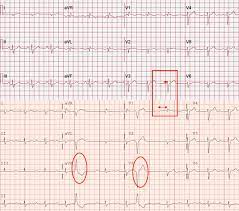 The american heart association (aha) recommends further testing for patients having signs consistent with myocarditis with 1 or more cardiac imaging methods such as echocardiogram or cardiovascular magnetic resonance (cmr).10the echocardiogram usually is more readily deployed because it is portable. Immune Checkpoint Inhibitor Myocarditis Pathophysiological Characteristics Diagnosis And Treatment Journal Of The American Heart Association
