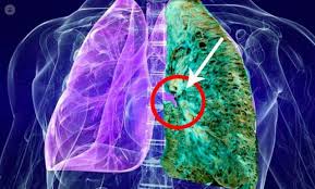 Idiopathic pulmonary fibrosis (ipf) is a progressive and fatal disease. Fibrosis Pulmonar Que Es Sintomas Causas Prevencion Y Tratamiento Top Doctors