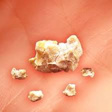 Definition Of Kidneystones Kidney Stones Are Solid Depositions Or Crystal Aggregations In Any Region Of The Kidneys Usually O Kidney Stones Kidney Crystals