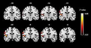 1904, lucy maud montgomery, penelope's party waist in short stories: Frontiers Increased Gray Matter Volume And Resting State Functional Connectivity In Somatosensory Cortex And Their Relationship With Autistic Symptoms In Young Boys With Autism Spectrum Disorder Physiology