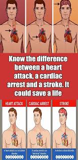 Sudden coronary death (type 3), including cardiac arrest, often with symptoms of presumed myocardial ischemia with the expected new st the most common and characteristic symptom of myocardial infarction is pain. Differences Between A Heart Attack Cardiac Arrest And Stroke That You Must To Know Heart Attack Heart Attack Symptoms Cardiac