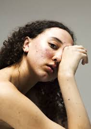 Sophie Harris-Taylor Challenges the Notion of Perfect Skin With Her  Epidermis Photography Project