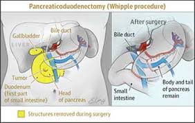 What The Whipple Understanding The Whipple Procedure Lewisgale Physicians