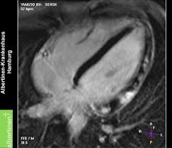 More specifically, it is described as. Myocarditis Mri Doccheck
