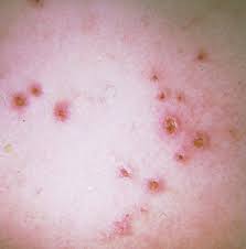 Over time, morgellons can affect your quality of life. Cutaneous Delusional Disorders Delusional Disorder Somatic Type Delusions Of Parasitosis Ekbom S Disease Morgellons Disease Body Dysmorphic Disorder Dermatology Advisor