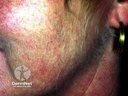 Image result for Hypertrichosis