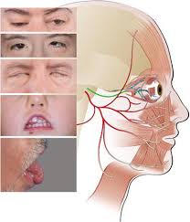 Mobius syndrome is a rare disorder. Differentiating Moebius Syndrome And Other Congenital Facial Weakness Disorders With Electrodiagnostic Studies Muscle Nerve X Mol