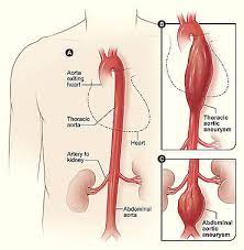 Dall'aorta che attraversa il torace e l'addome si dipartono le arterie principali che portano il sangue alle varie parti del corpo. Aneurisma Aortico Sintomas Del Aneurisma Cirujano Vascular San Francisco