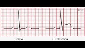 Image result for ST Segment