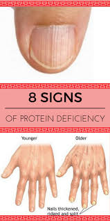 8 Signs Protein Deficiency All About Of