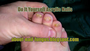 The fact that you can do it by yourself saves you the salon expenses. About Nail Fungus Do It Yourself Acrylic Nails