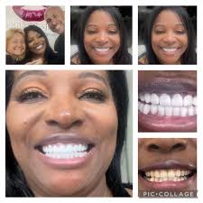 Porcelain veneers in Cali Colombia