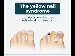 Image result for Yellow nail syndrome feet