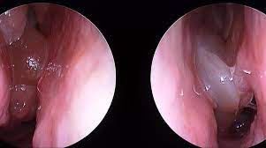 They line the inside of nasal polyps are a subgroup of chronic rhinosinusitis. Modern Treatment For Nasal Polyps And Sinusitis