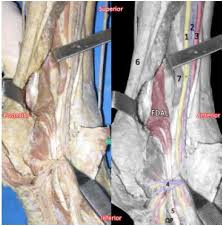 A flexor tendon laceration is a deep cut on the palm side of the fingers, hand, wrist, or forearm that can injure the flexor tendon. Descripcion Morfologica Del Musculo Flexor Largo Accesorio De Los Dedos Y Su Significancia Clinica