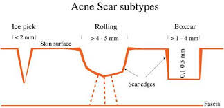 Image result for ice pick scars