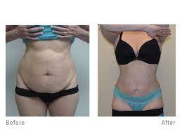 Heads up though, i am not going to sugar coat my laser lipo/mini tummy tuck journey. Mini Tummy Tuck Colleyville Plastic Surgeon Dr Jon Ver Halen