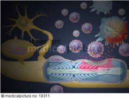 With ms, your immune system attacks myelin, which is the protective layer around nerve fibers. Multiple Sclerosis Ms Doccheck