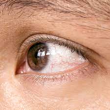 Steht die konjunktivitis in zusammenhang mit einem viralen infekt der atemwege (grippaler infekt), kann künstliche tränenflüssigkeit eingesetzt werden. Bindehautentzundung Oder Gerotete Augen Durch Covid 19 Geht Das Unser Auge