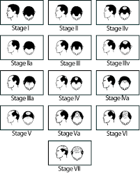 Un ragazzo su 5 (il 18% del campione di analisi) di età compresa tra i 12 e i 20 anni soffre di calvizie giovanile e quindi perdita dei capelli . Caduta Dei Capelli