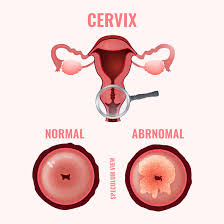 The meaning of the positive result depends on the types of cells discovered in the test. Pap Test Papanicolaou Smear Harvard Health