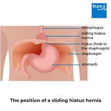 Image result for stomach hernia symptoms