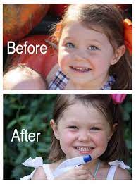 You can reverse cavities naturally by removing sugar eliminating phytic acid consuming raw dairy and nutrient rich. How To Reverse Tooth Decay My Daughter S Story