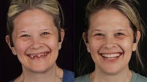 All-on-4 Dental Implants Chattanooga — Hixson Dental Group