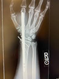Image result for Scapholunate Dislocation