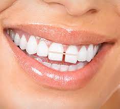Invisalign invisalign braces are great for closing the gaps in your teeth as well as straightening crooked teeth. Get Rid Of The Gap Between Your Teeth Without Braces En 2019 Avoir Les Dents Blanches Blanchir Les Dents Et Blanchir Les Dents Naturellement
