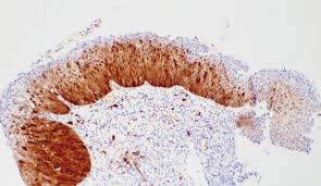 Secondary Prevention Of Cervical Cancer
