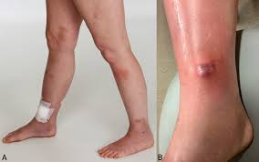 Image result for Panniculitis