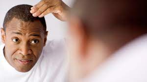 It was months of falling out and then it stopped being so heavy slowly. When Hair Loss Is Not Genetic Everyday Health