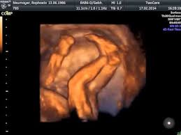 Organscreening Ssw 22 5 Youtube
